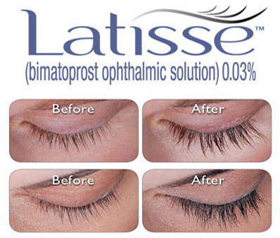 latisse-lumigan-before-and-after